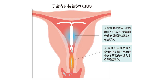 避妊のメカニズムの画像