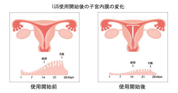 生理の出血量（経血量）が減少し、生理痛を緩和します。の画像